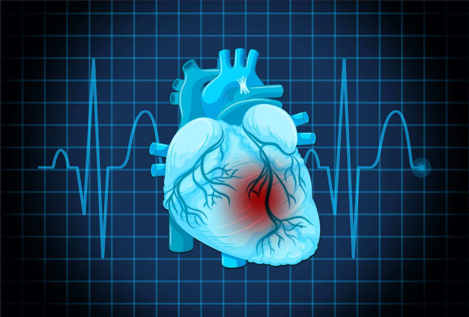 Aritmie Cardiache: Sintomi, Diagnosi e Cure per il Battito Irregolare